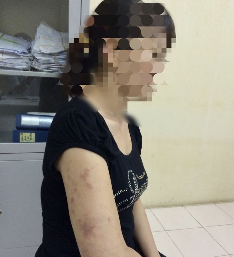 Bệnh nhân có nhiều tổn thương trên da.