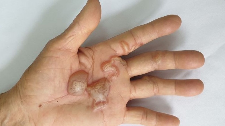 Nhiễm ký sinh trùng từ động vật nuôi trong nhà