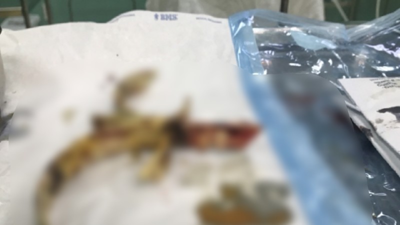 Dị vật kim loại (bông cửa sắt hàng rào) cắm chặt vào hộp sọ độ sâu 4-5 cm.
