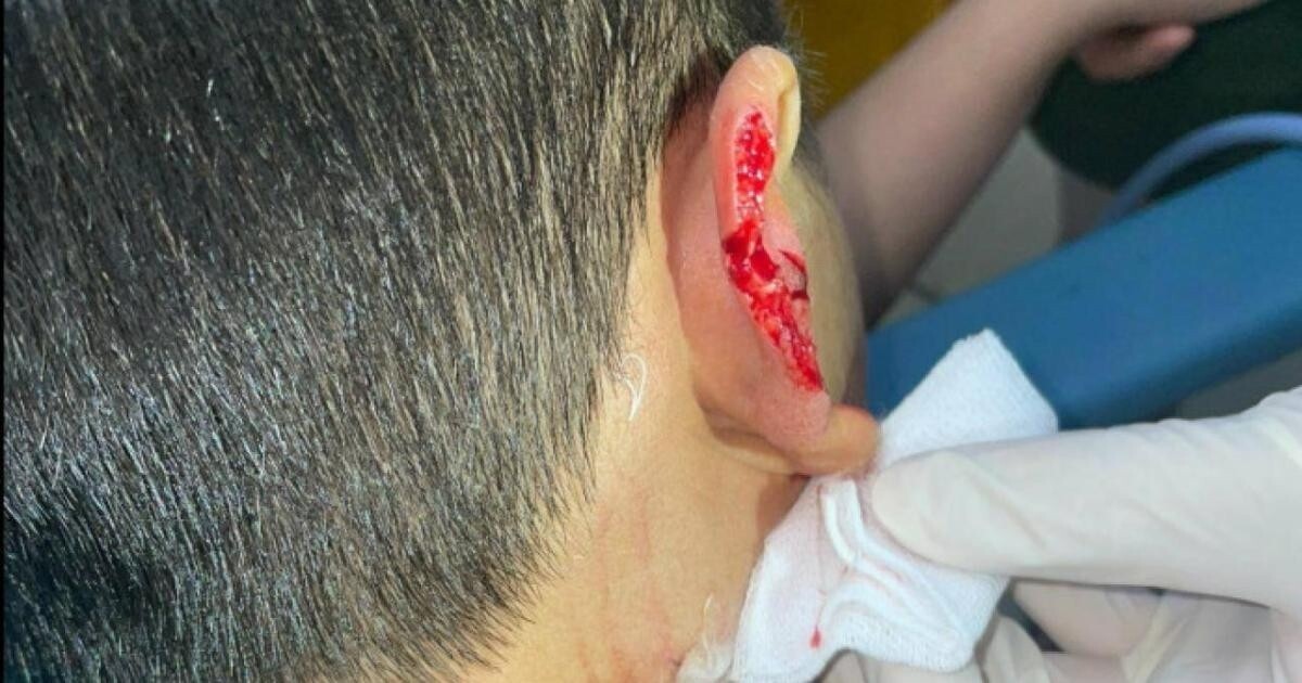 Bé N bị chó lạ tấn công, cắn đứt vành tai.