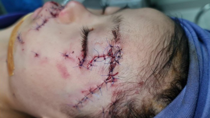 Bé L được phẫu thuật ghép da phần tổn thương trên mặt do chó cắn.