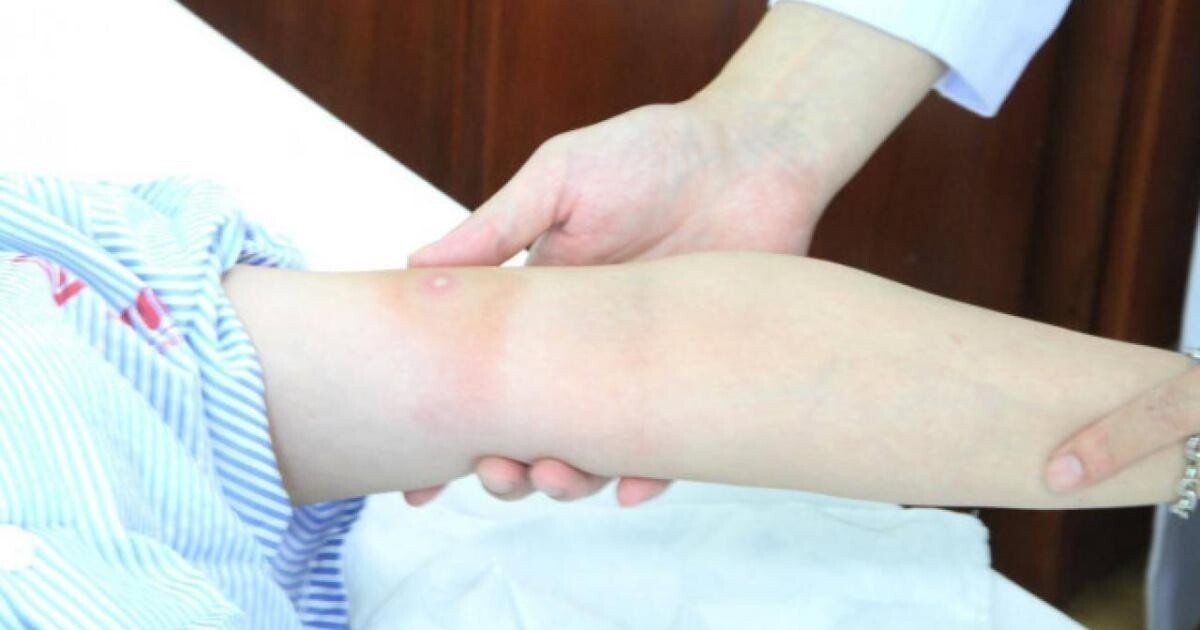 Vết ong đốt trên cánh tay bệnh nhân N.