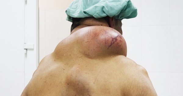 Nghiện rượu, người đàn ông biến dạng vùng gáy vì u mỡ khủng