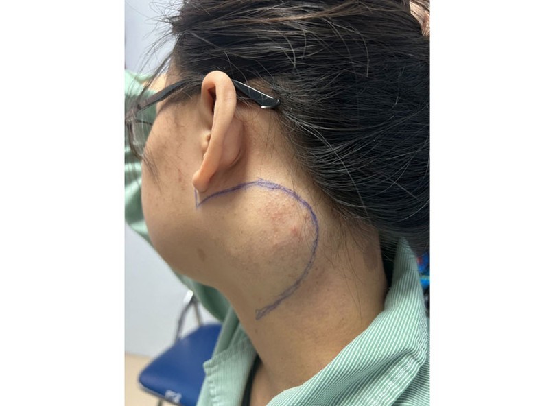 Vị trí khối u của người bệnh trước khi được các bác sĩ thực hiện ca phẫu thuật.