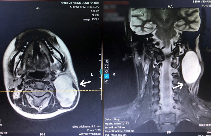 Hình ảnh chụp cộng hưởng từ cho thấy khối u có kích thước lớn, nằm ở vị trí nguy hiểm, gần các dây thần kinh trọng yếu.
