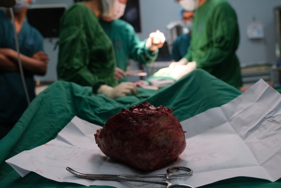 Khối bướu cổ khủng được các bác sĩ phẫu thuật cắt bỏ.