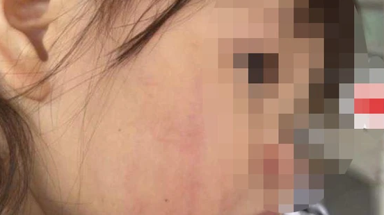 Bé 2 tuổi vỡ thành mạch vì bị cô giáo tát liên tiếp