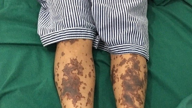 Thêm một bệnh nhân mắc bệnh liên cầu lợn ở Đắk Lắk