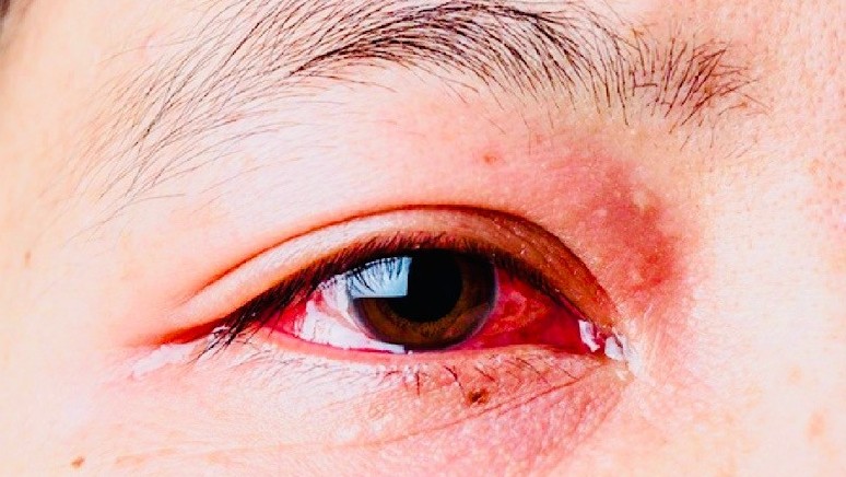 Bệnh đau mắt đỏ đang có nguy cơ bùng phát ở Hải Phòng