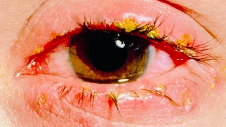 Bệnh đau mắt đỏ không được điều trị đúng cách dễ gây biến chứng, ảnh hưởng đến thị lực người bệnh.