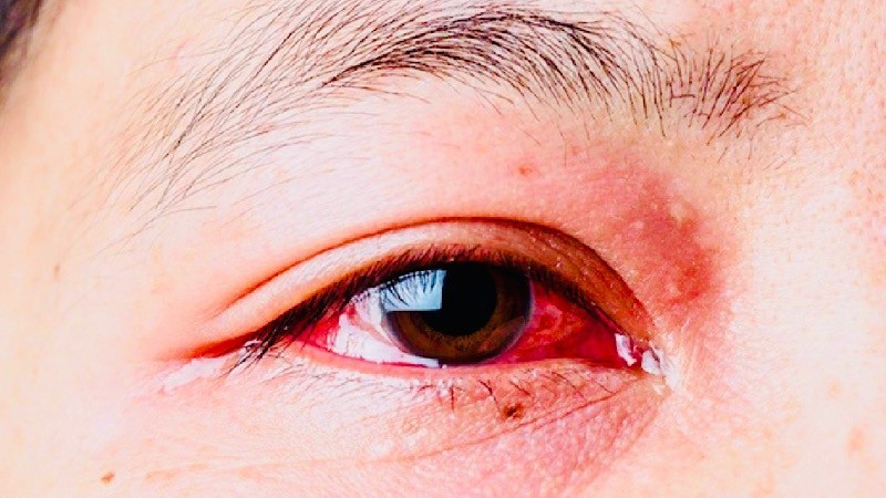 Bệnh đau mắt đỏ đang có nguy cơ bùng phát trên địa bàn thành phố Hải Phòng nếu không được phòng tránh tốt.