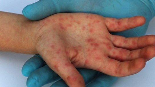 8 người liên quan ca mắc bệnh đậu mùa khỉ tại TP.HCM phải cách ly 21 ngày