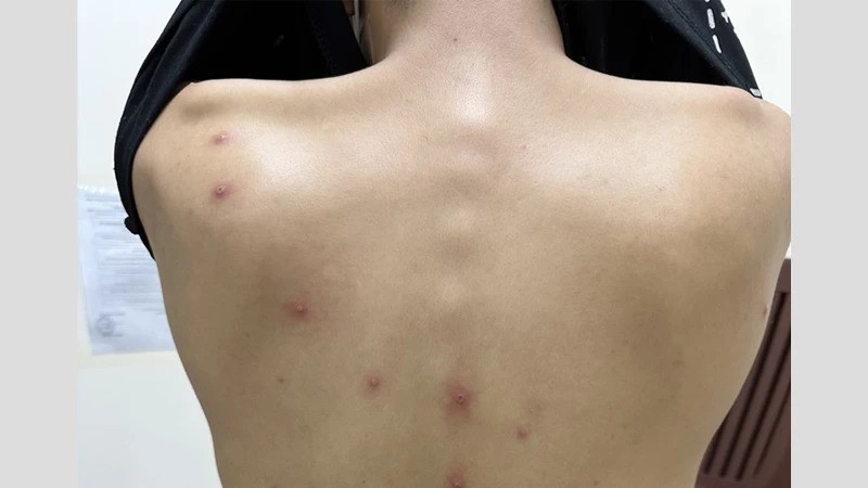 Tính đến nay, Thành phố Hồ Chí Minh đã ghi nhận 4 ca bệnh đậu mùa khỉ trong tổng số 5 trường hợp của cả nước.