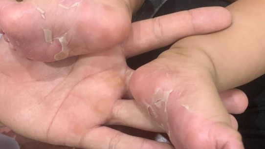 Vì sao trẻ sơ sinh cũng mắc bệnh giang mai?