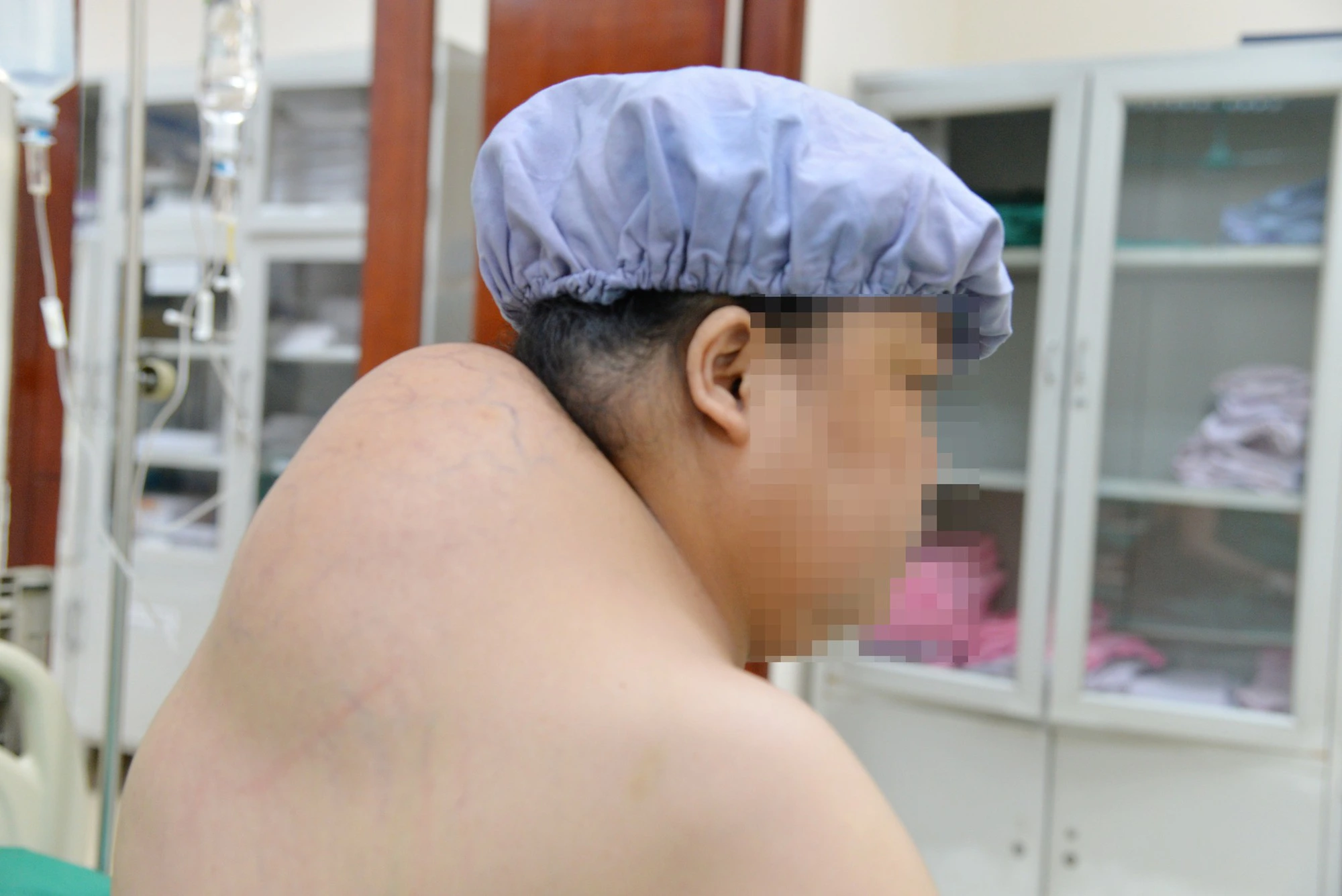 Khối u mỡ khổng lồ gây biến dạng vai gáy người phụ nữ ở Hà Nội