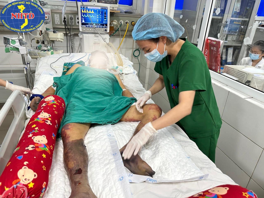 Thích ăn nem chạo, thịt lợn sống, người đàn ông nguy kịch vì nhiễm khuẩn liên cầu lợn