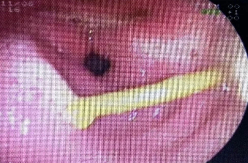 Một bệnh nhân bất cẩn nuốt cây tăm gần 5cm