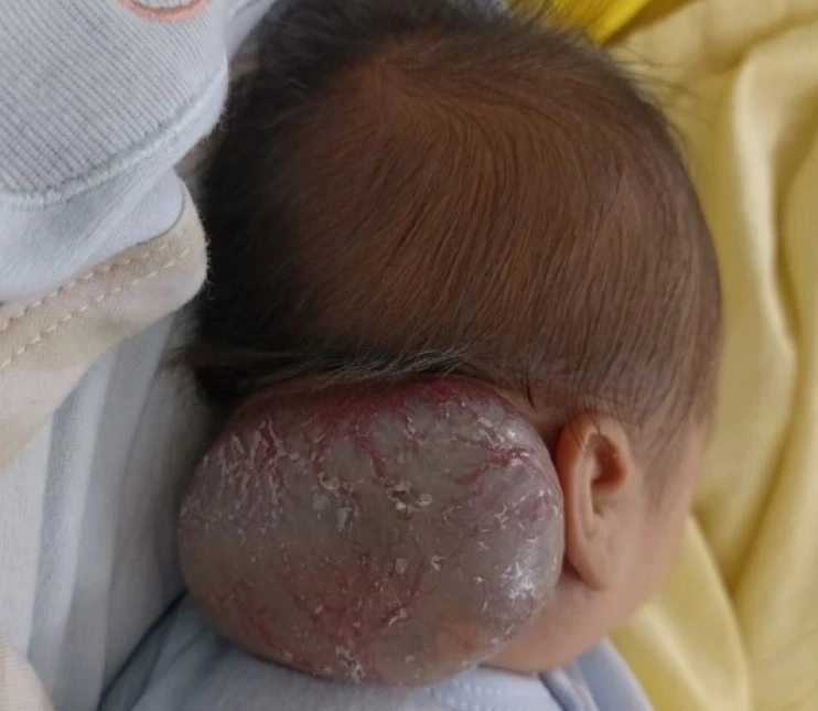 Loại bỏ khối u máu hiếm gặp cho bệnh nhi 14 ngày tuổi