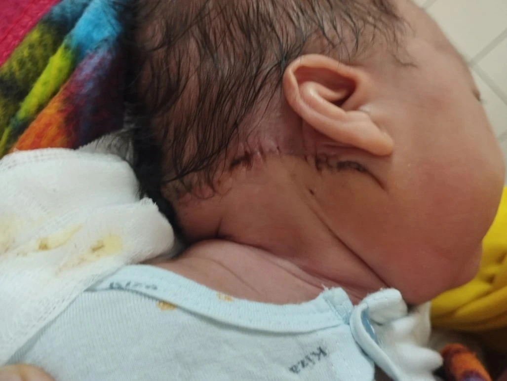 Loại bỏ khối u máu hiếm gặp cho bệnh nhi 14 ngày tuổi