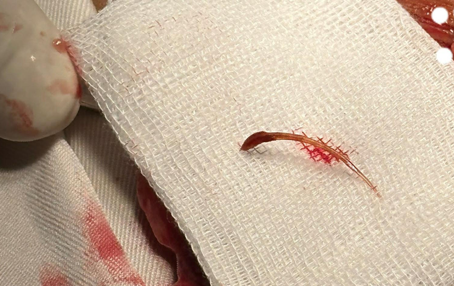 Một bệnh nhân ở Long An nuốt xương cá bị viêm ruột thừa