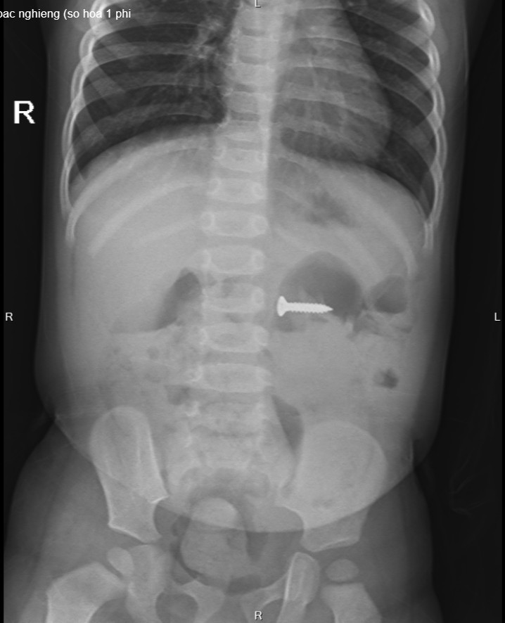 Gắp đinh vít sắc nhọn trong bụng bé gái 2 tuổi