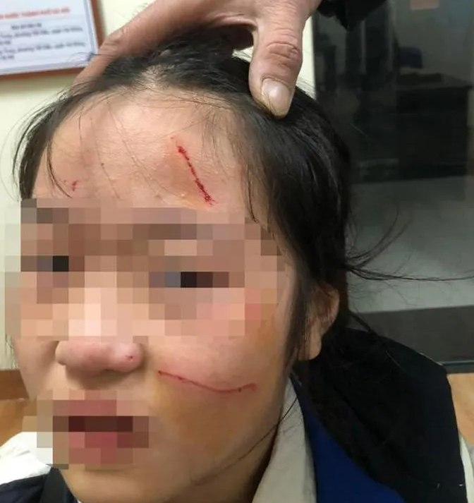 Vụ nữ sinh lớp 6 nghi bị bạn dùng dao rạch mặt: Kết quả xác minh thế nào?