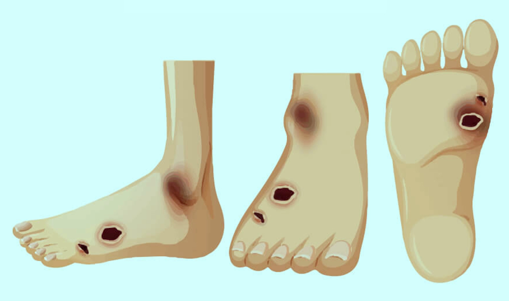 Tránh biến chứng bàn chân ở người mắc tiểu đường