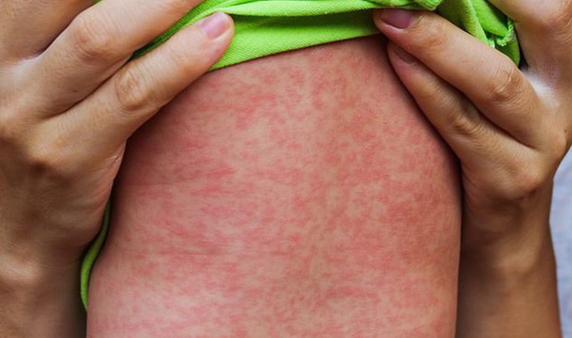 3 lý do khiến bệnh sởi dễ bùng dịch sau Tết