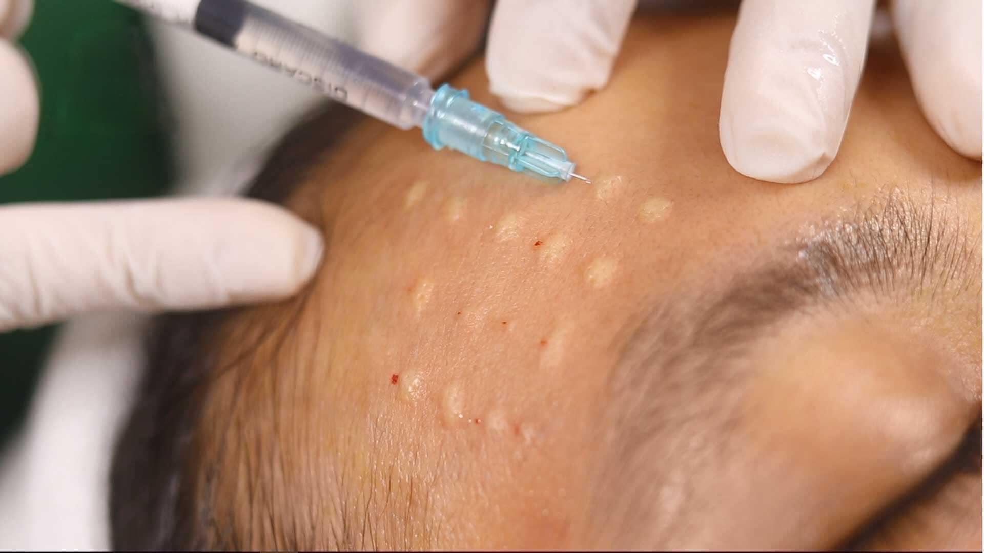 Vì sao nhiều người tiêm meso trẻ hóa da gặp biến chứng?