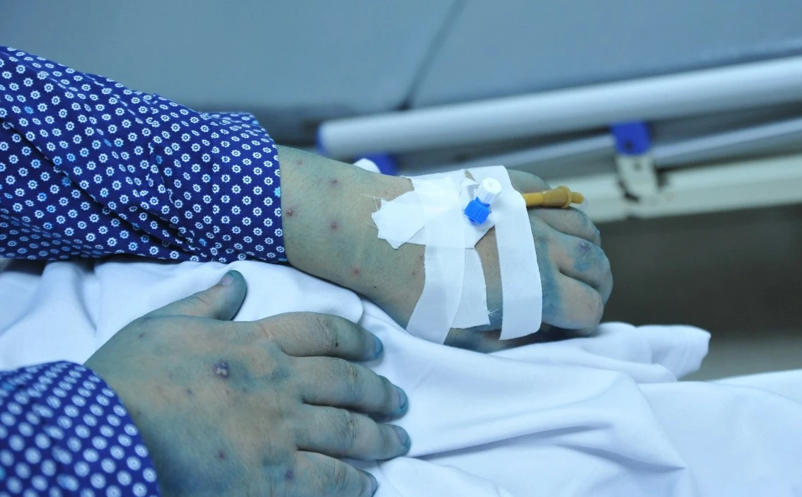 Nhiều bệnh nhân thủy đậu và ho gà nhập viện vì biến chứng