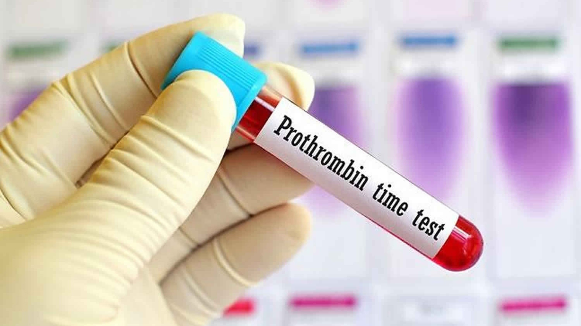 Có cần thiết làm xét nghiệm sàng lọc cục máu đông?