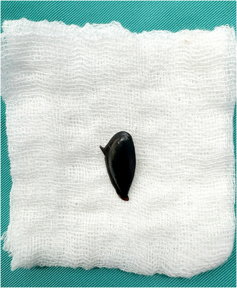 Cụ bà 90 tuổi nguy kịch vì hóc hạt hồng xiêm