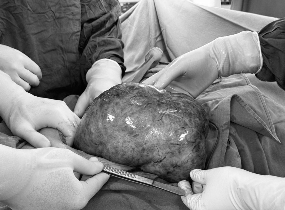 Tự dùng thuốc, 1 phụ nữ nguy kịch với khối ung thư buồng trứng "khủng"