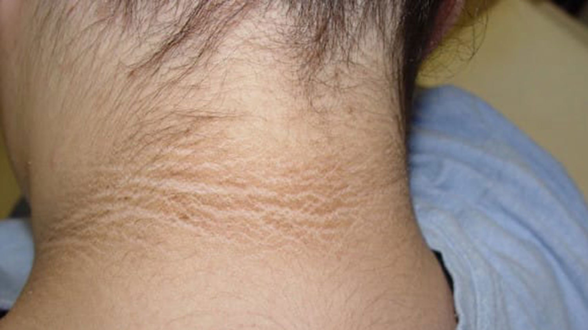 Trẻ béo phì có vệt đen vùng cổ, có đáng lo?