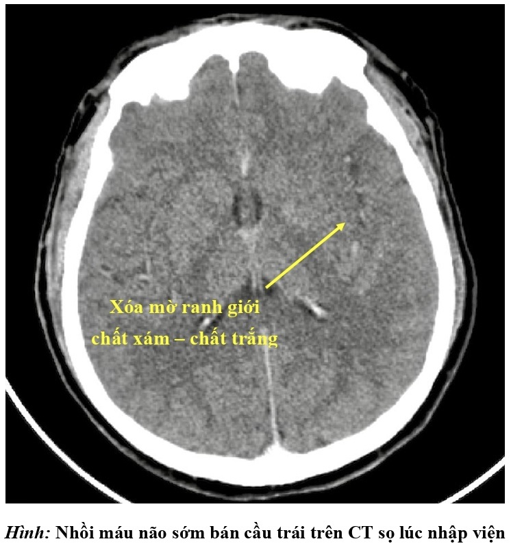 Người đàn ông đột quỵ sau khi giác hơi chữa đau lưng, đau vai gáy tại nhà
