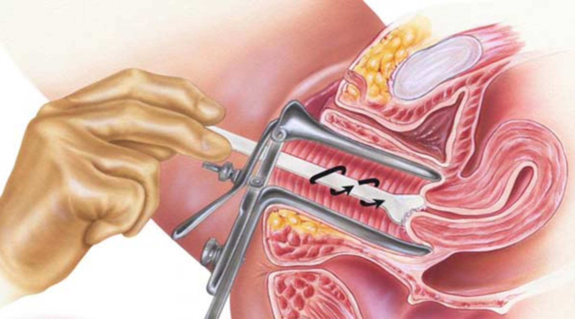 Ung thư cổ tử cung có thể tầm soát sớm?