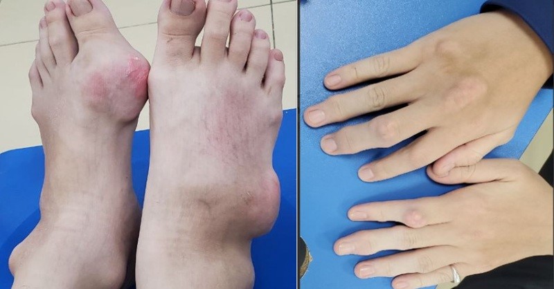 Khớp ngón tay, chân nam thanh niên biến dạng vì bệnh gout