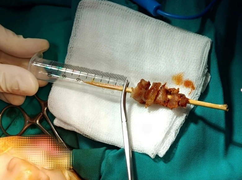Bé gái 2,5 tuổi bị que xiên thịt đâm sâu nguy cơ xuyên sọ não- Ảnh 1.