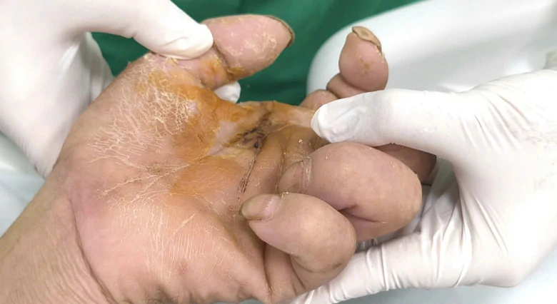 Bị gà mổ vào chân, cụ ông 94 tuổi nguy kịch vì uốn ván Bị gà mổ vào chân, cụ ông 94 tuổi nguy kịch vì uốn ván - Ảnh 2.