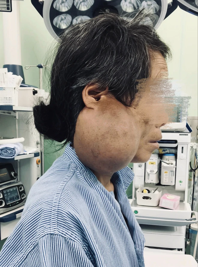 Phẫu thuật thành công khối u tuyến mang tai khổng lồ hơn 10cm cho 1 phụ nữ Mông Phẫu thuật thành công khối u tuyến mang tai khổng lồ hơn 10cm cho 1 phụ nữ Mông - Ảnh 1.