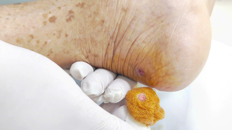 Bị gà mổ vào chân, cụ ông 94 tuổi nguy kịch vì uốn ván Bị gà mổ vào chân, cụ ông 94 tuổi nguy kịch vì uốn ván - Ảnh 3.