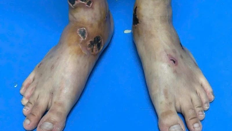 Điều trị thành công ca bệnh viêm mạch hiếm gặp