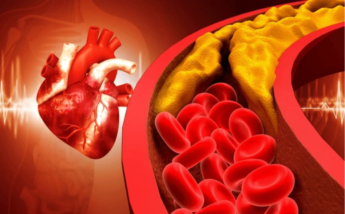 Tăng huyết &aacute;p l&agrave; thủ phạm g&acirc;y xơ vữa động mạch
