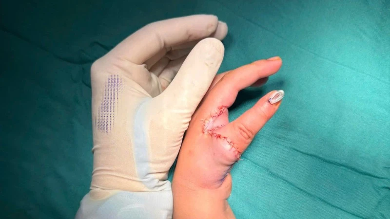 Tái tạo ngón cái cho trẻ bằng chính ngón trỏ, mở ra cơ hội mới cho trẻ mắc dị tật bẩm sinh