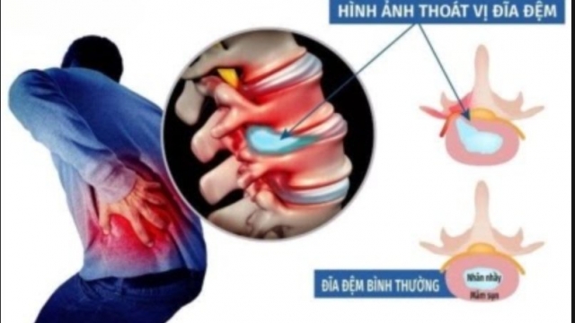 Mổ thoát vị đĩa đệm xong, người bệnh cần làm gì để phục hồi tốt và hạn chế tái phát?