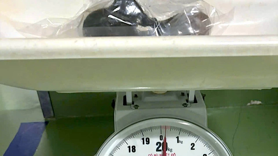 Lấy khối tóc nặng 250g khỏi bụng bé gái 5 tuổi ở Cà Mau