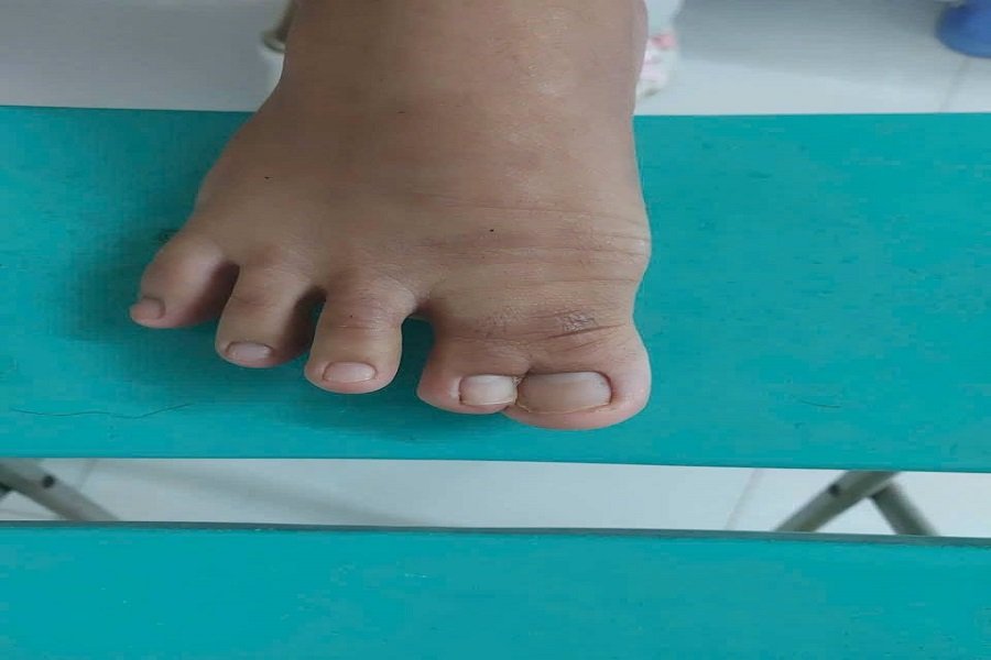 Trước phẫu thuật, b&agrave;n ch&acirc;n phải của bệnh nhi d&iacute;nh ho&agrave;n to&agrave;n ng&oacute;n ch&acirc;n c&aacute;i (ng&oacute;n I) v&agrave; ng&oacute;n thứ II dạng m&agrave;ng. (Ảnh: Bệnh viện II L&acirc;m Đồng)