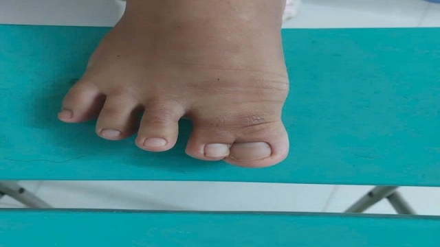 Bệnh viện II Lâm Đồng tách dính ngón chân bẩm sinh hiếm gặp