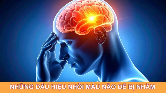 Những dấu hiệu nhồi máu não dễ bị nhầm với bệnh thông thường