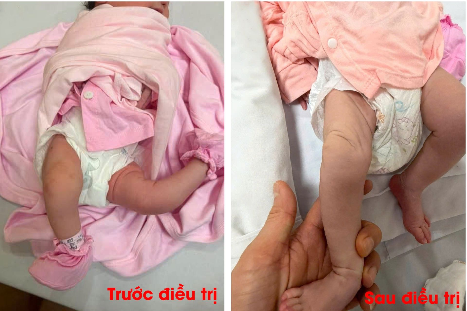 Bệnh viện Nhi Hải Phòng nắn chỉnh thành công ca biến dạng khớp gối duỗi quá mức bẩm sinh Bệnh viện Nhi Hải Phòng nắn chỉnh thành công ca biến dạng khớp gối duỗi quá mức bẩm sinh